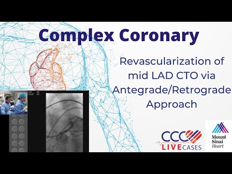 Revascularization of mid LAD CTO via Antegrade/Retrograde Approach - CCC Live Cases - April 21, 2015