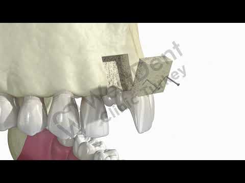 Logo of Practical Overview of the Block Dental Bone Graft and Implant Procedure in Izmir, Turkey