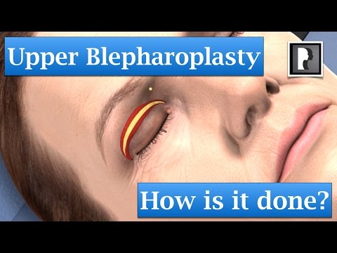 Upper Blepharoplasty - How is it done? An animation showing how upper eyelid surgery is completed.