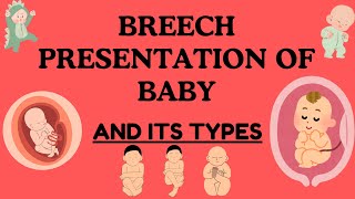 Breech Presentation of Baby: Understanding, Types, Risks, and Delivery Options
