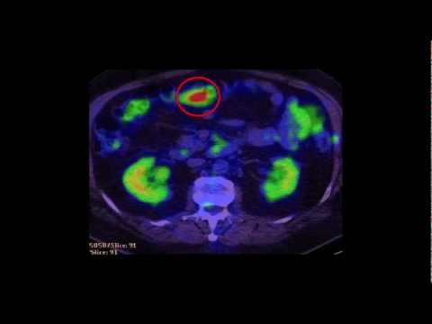 Colon Carcinoma - Laparoscopic Colon and Liver Resection