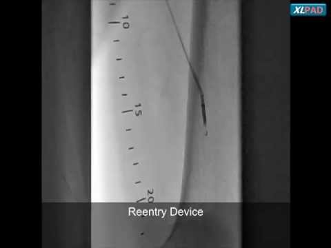 TruePath to Cross Left SFA CTO with Subintimal Re-Entry