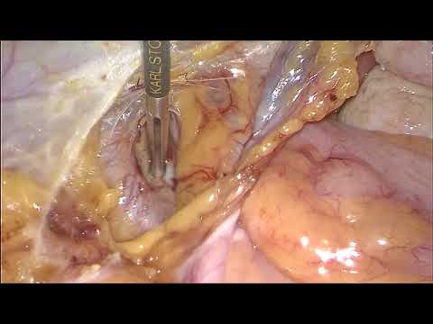 Клиппирование внутренней подвздошной артерии