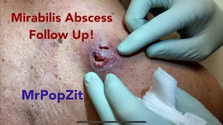 Giant Proteus Mirabilis infected abscess follow up! 48 hours/ 7 day/ 14 day/ 3 month Transformation