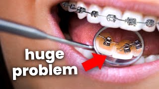 What happens if you have BRACES for too long…