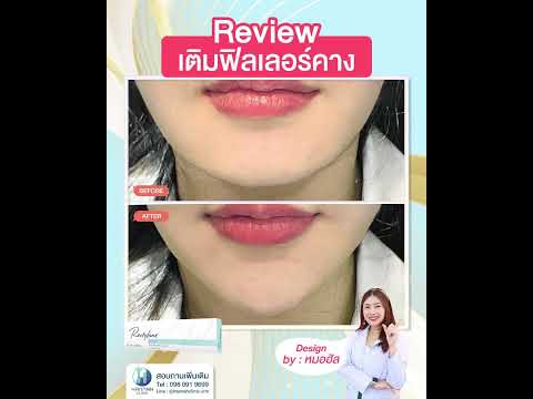 รีวิวหัตถการโปรแกรมฟิลเลอร์คาง