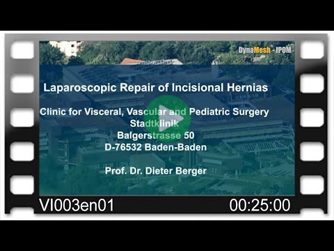 DynaMesh®-IPOM - OR-Video: Laparoscopic Repair of Incisional Hernias