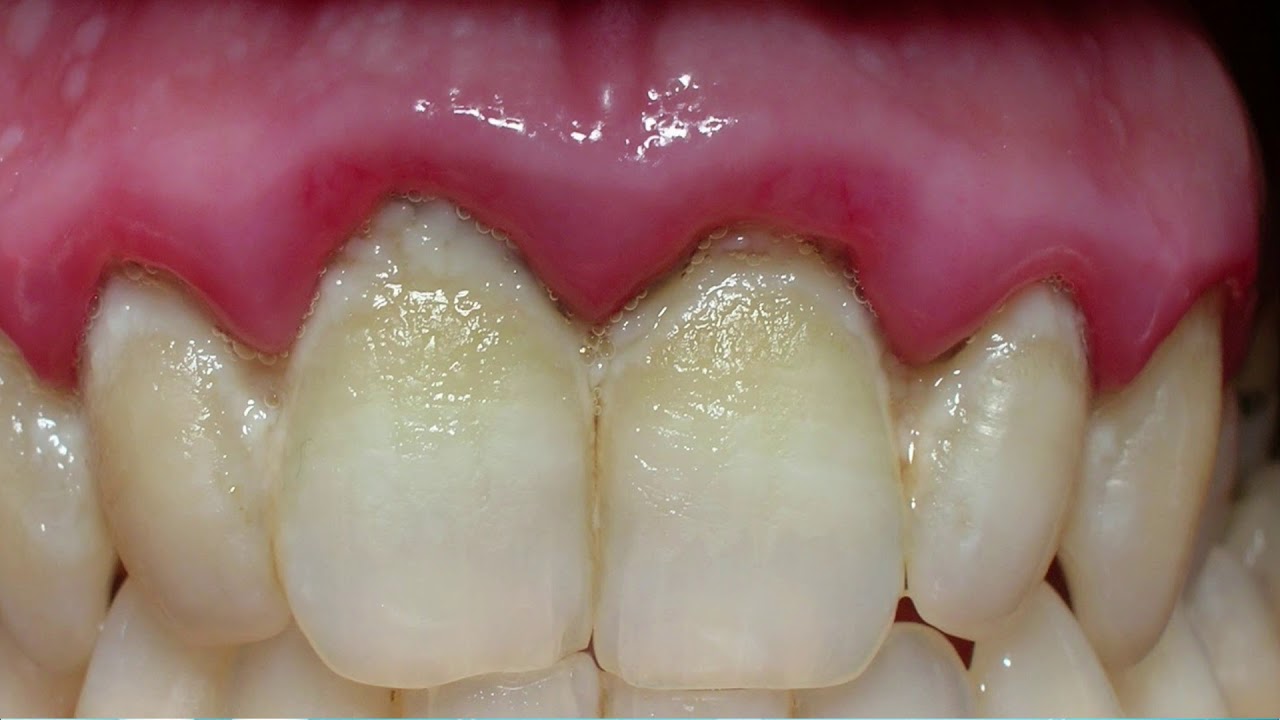 ENFERMEDAD PERIODONTAL/inflamacion o retracción de la encía, que es, como se origina,tratamiento.