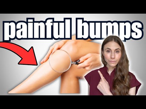 Painful Red Bumps on Legs? The Truth About Erythema Nodosum