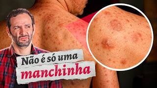 POR QUE o SARAMPO é PERIGOSO? COMO se PROTEGER?