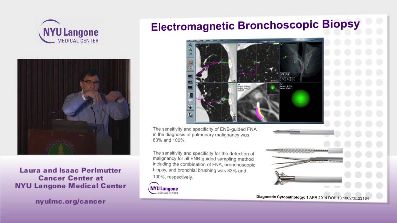 Update on Lung Cancer: What’s Happening in Lung Cancer Screening?