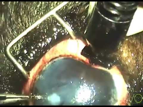 Anteprima Video Chirurgia del glaucoma nel cane