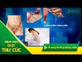 U nang buồng trứng xoắn: biến chứng đe dọa tính mạng!