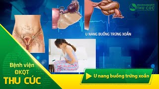 U nang buồng trứng xoắn: biến chứng đe dọa tính mạng!