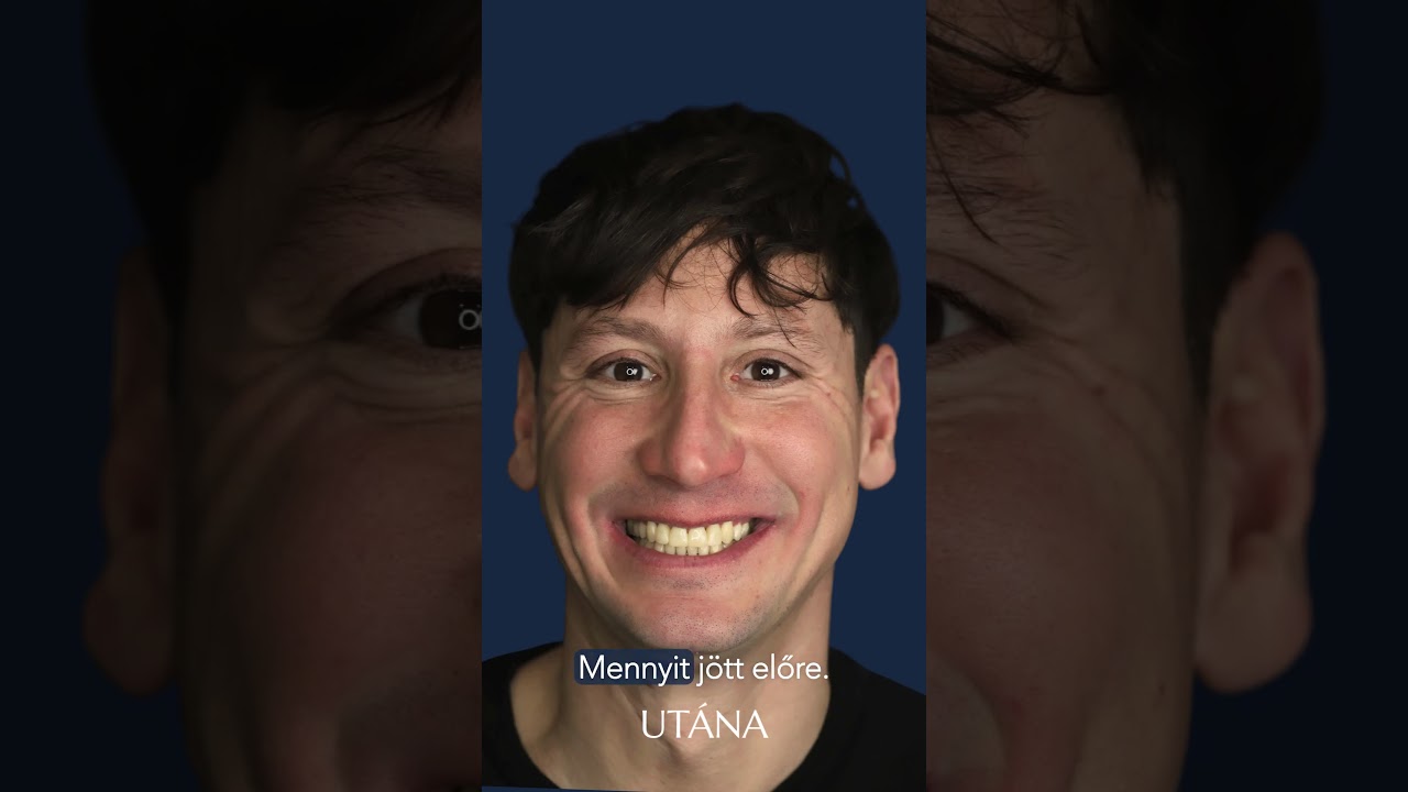 Fogszabályozás felnőttkorban? ⁉️Páciens élmény videó - Dr. Kovács Sarolta szakorvos #fogszabályozás