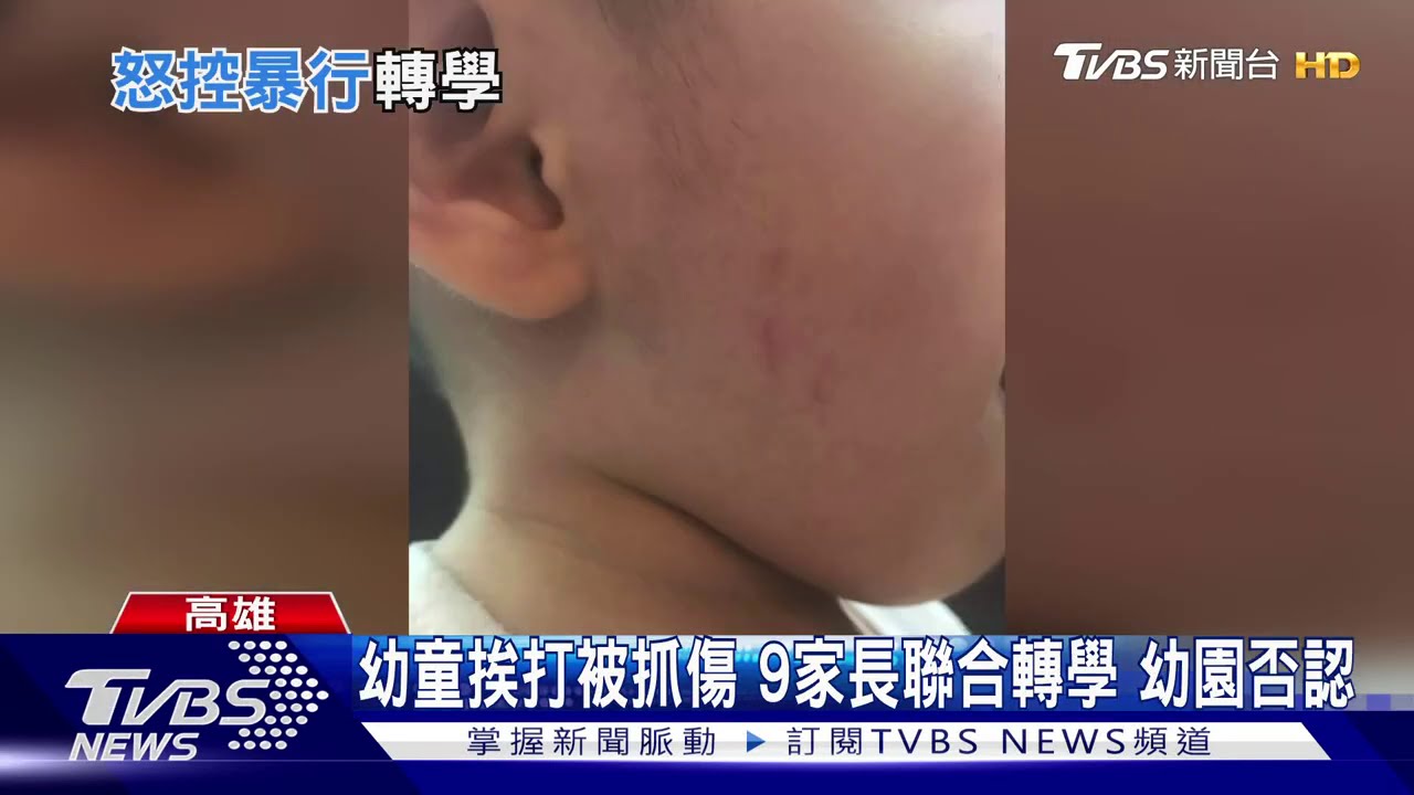 幼童挨打被抓傷！9家長聯合轉學　幼園否認