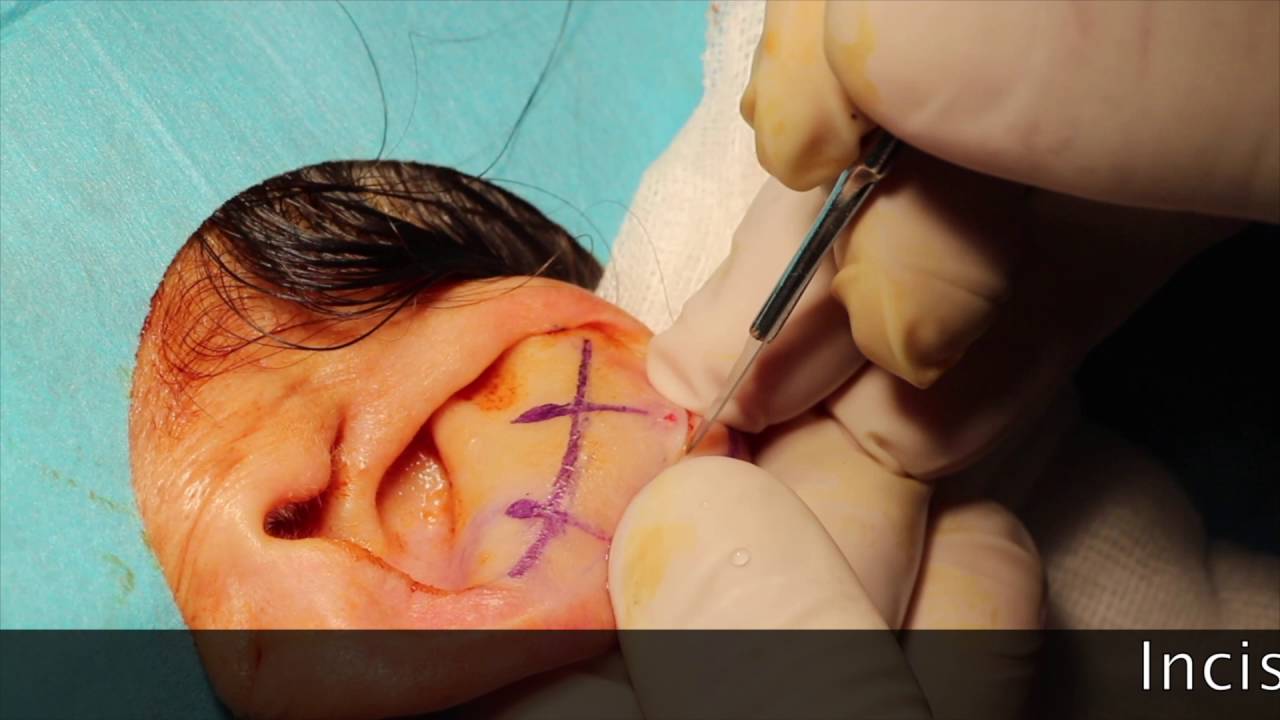 Earfold - orecchie a ventola corrette in modo semplificato