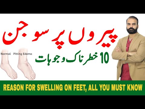 10 Dangerous Reasons for Swelling on Feet - What causes swollen legs and feet??Edema in Hindi/Urdu?