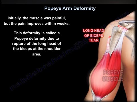 Rupture du tendon du biceps proximal / déformation de Popeye