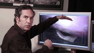 Hemorrhagic vocal cord polyps Part II (HD)