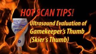 Hot Tip-Ultrasound Evaluation of Gamekeeper's Thumb aka Skier's Thumb