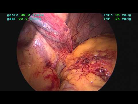 Agenesis Of The Left Hemidiaphragm:  A Case Report