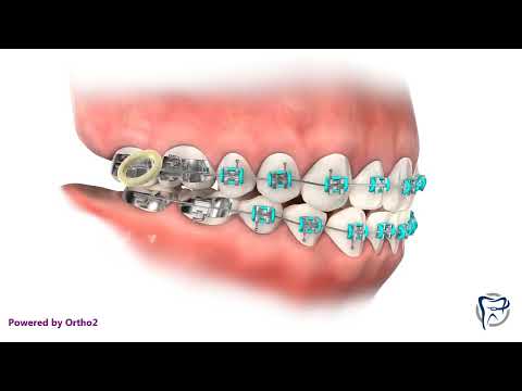 Class III Elastics-Sınıf III Elastik Kullanımı