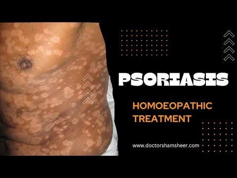 Psoriasis