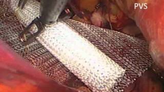 Laparoscopic bilateral TEP for Inguinal Hernia