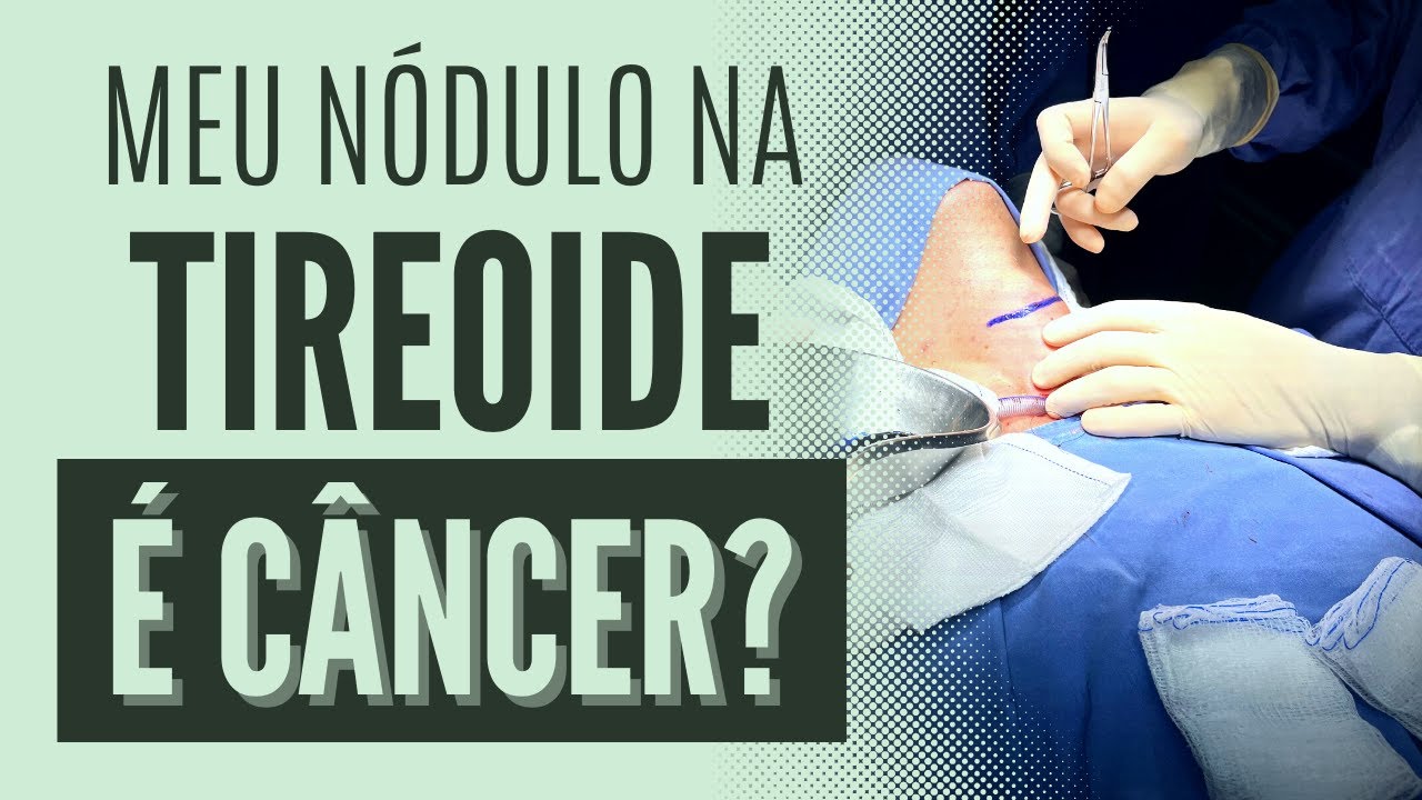 Câncer da tireoide - como diagnosticar?