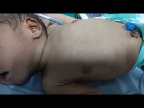Is This A Case Of Tracheolaryngomalacia?