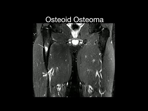 Osteoid Osteoma