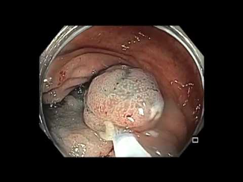 Dezentes Polyp des Blinddarm