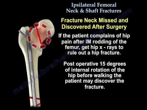 Ipsilateral Femoral Neck & Shaft Fractures - Everything You Need To Know - Dr. Nabil Ebraheim
