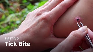 First Aid: Tick Bite | First Aid