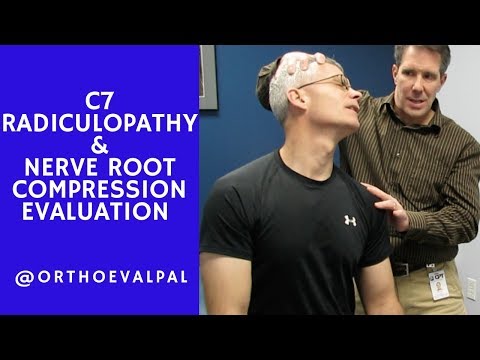 Positive Hoffman s Sign Hyperreflexia and Spurling s Test