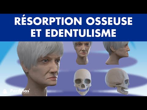 Résorption osseuse et edentulisme ©