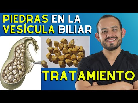 🥑 Symptoms and TREATMENT of Gallstones (Cholelithiasis and Cholecystitis)