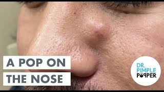 An Excor-CYST-em... with Dr Pimple Popper