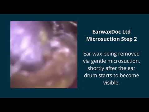 EarwaxDoc Microsuction ear wax removal of occluded ear canal
