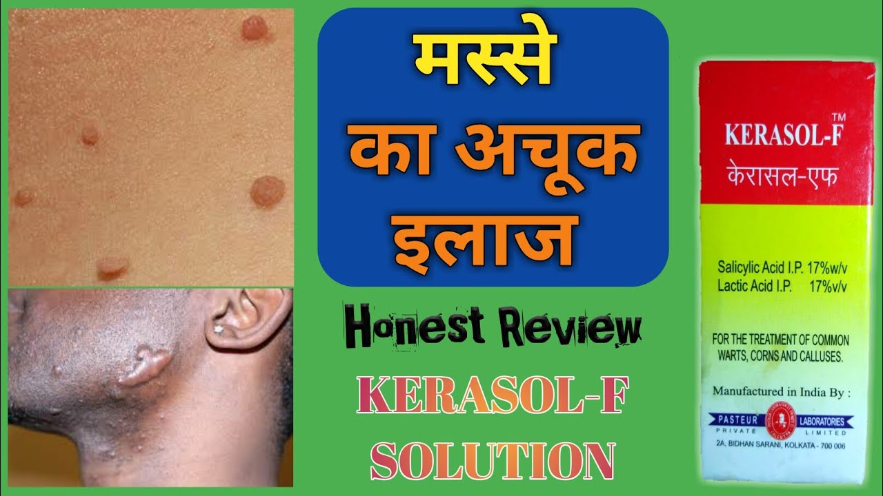 Kerasol F Uses | Warts & Corns Treatment | Masse Ka Ilaj | Salicylic Acid Lactic Acid In Hindi