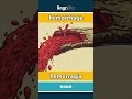hemorrhage - hemorragia video thumbnail