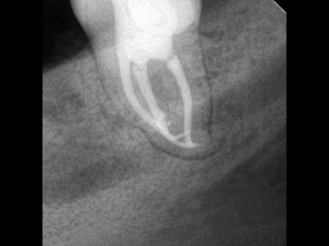 Лечение восьмерки системой S flexy