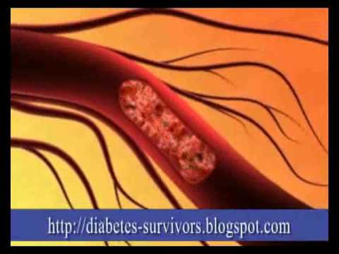 Anzeichen von erhöhter Blutzucker und Diabetes Schwarzkümmelöl von Diabetes