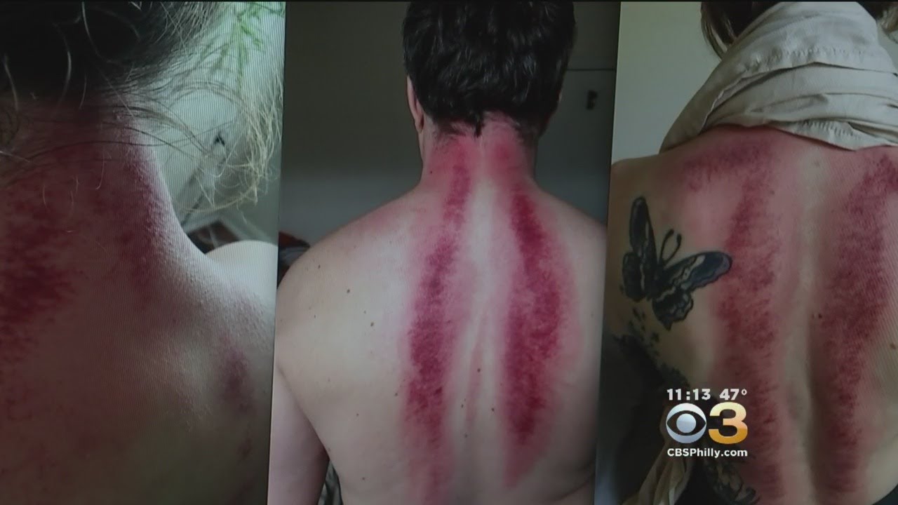 ‘Gua Sha’ Treatment Creates Bruises To Relieve Pain