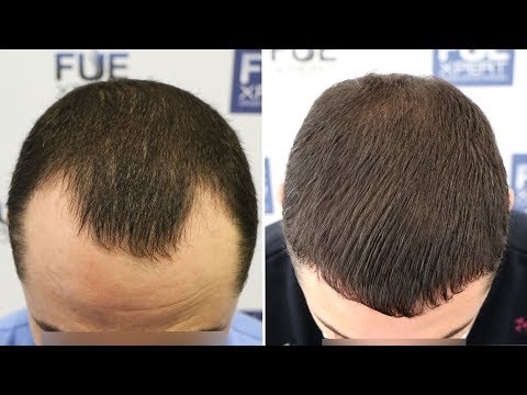 FUE Hair Transplant (2540 Grafts in NW Class 3-A) By...