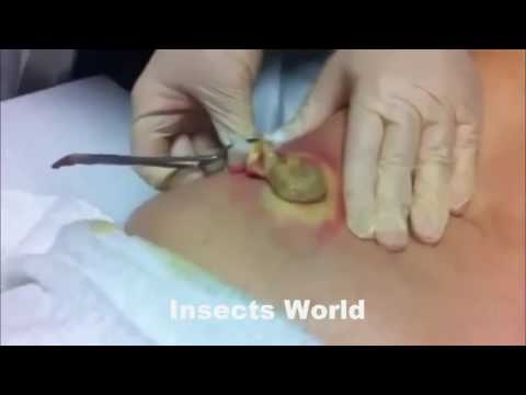 Hogyan lehet meggyógyítani a pinwormokat