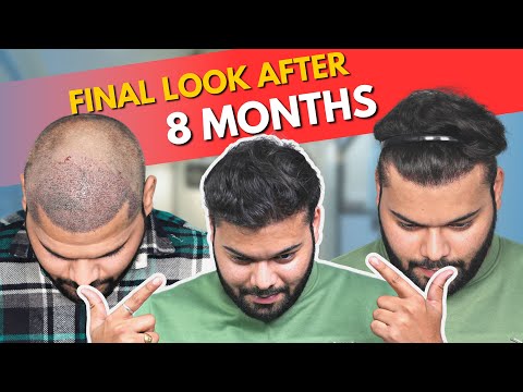 Hair Transplant in Chennai| Best Results & Cost of...