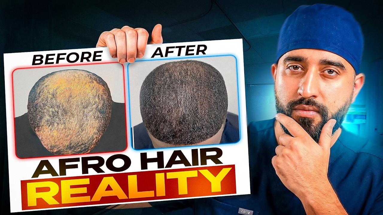 Afro Hair Transplant Method | Graft count, Differences & Technique (Men & Women)