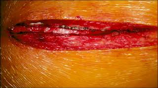 Download Lagu Off-Pump Single Vessel Coronary Artery Bypass (Mahesh Ramchandani, MD, M. Mujeeb Zubair, MD) Thumbnail